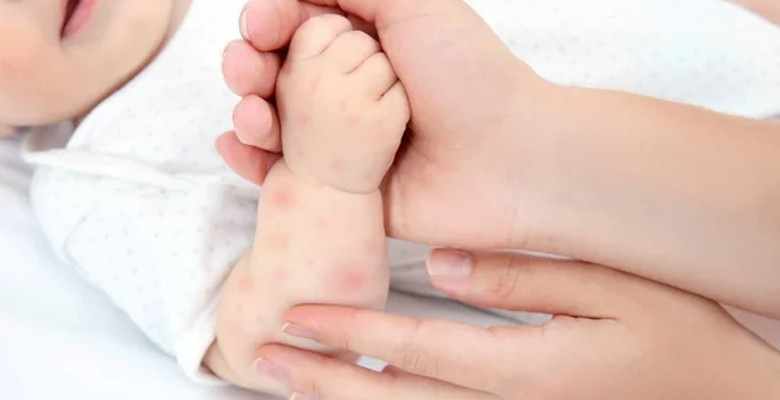 Uso de medicamentos para a acidez gástrica em bebés poderá conduzir ao desenvolvimento de doenças alérgicas